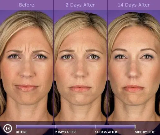 Wrinkles on a woman's face disappear over time after Botox treatment